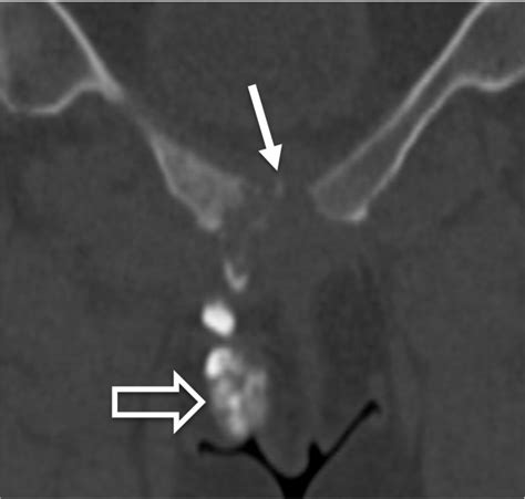 Osteomyelitis Pubis Caused By Kingella Kingaein An Adult Patient Report Of The First Case Bmc