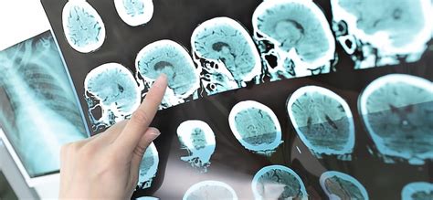Apa gejala awal tumor otak pada remaja? Tumor Otak: Gejala, Tanda, dan Pengobatan - Dokter Sehat