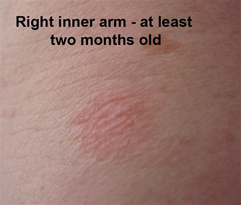 Raised Red Rash On Arms