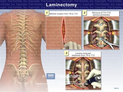 Laminectomy Trial Exhibits Inc