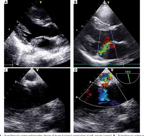 Figure 1 From Pediatric Mitral Valve Reconstruction In Acute