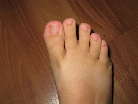 Maybe you would like to learn more about one of these? Yellow Toenail Removal@^*