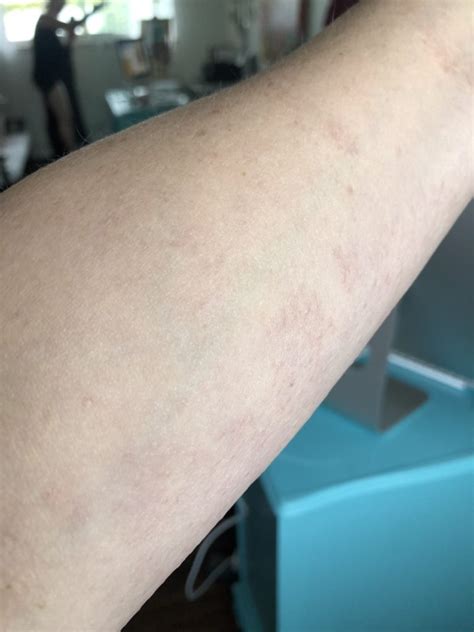 Liver Spots On Arms Photos