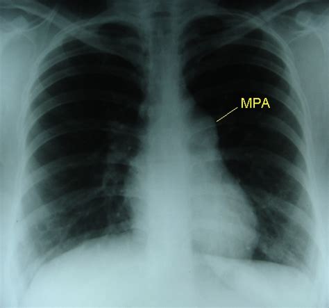 Pulmonary Stenosis X Ray Chest Pa View All About Cardiovascular