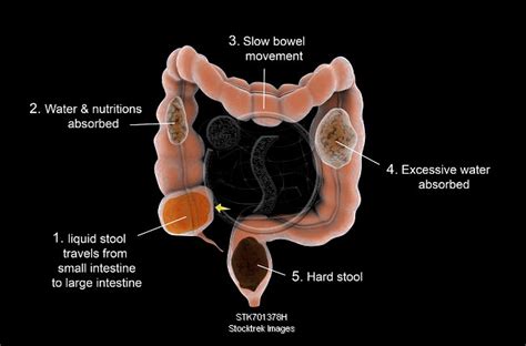 Medical Diagram Illustrating Constipation In The Human Intestines