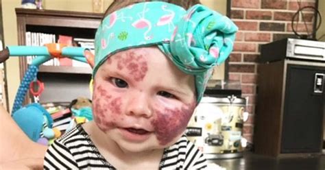 Baby Born With Purple Birthmark Covering Her Face And Body Set To