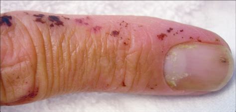 Leukocytoclastic Vasculitis As The Presenting Feature Of Dermatitis