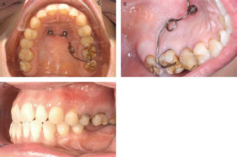 Maxillary Molar Intrusion Using Mini Implants In The Anterior Palate Mousetrap Versus Mini