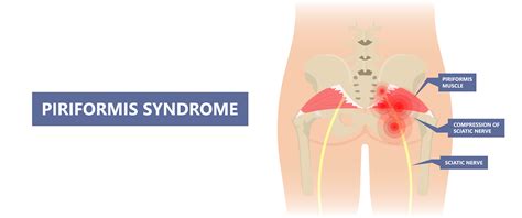 How To Stretch And Strengthen A Painful Piriformis Muscle