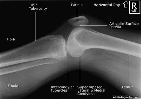 Knee Trauma Radiographic Anatomy WikiRadiography