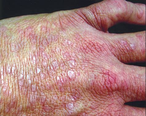 Lichenoid Eruption In A Patient With Aids—quiz Case Jama Dermatology