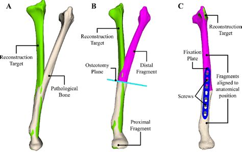 Diagram of of a long bone. Overview of state-of-the-art preoperative planning of long-bone... | Download Scientific Diagram