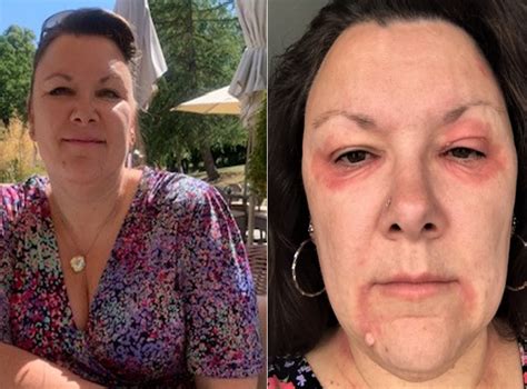 Creams For Eczema Woman Whose Menopause Skin Condition Made Her ‘look Like A Vampire’ Praises