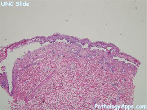 Erythema Multiforme Pathology