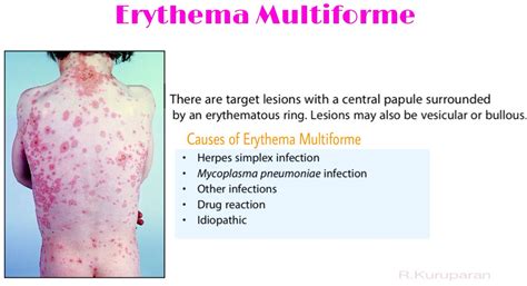 Erythema Multiforme Dermatology Nurse Skin Assessment Dermatology