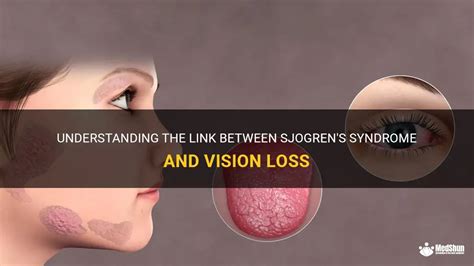 Understanding The Link Between Sjogrens Syndrome And Vision Loss Medshun