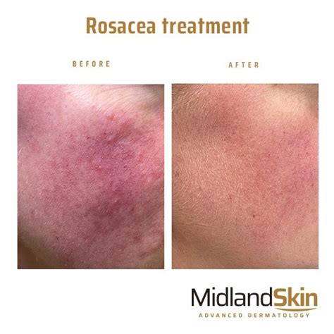 Rosacea Redness And Flushing Birmingham Midland Skin