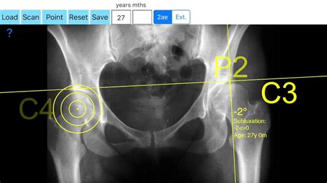 How To Measure The Centre Edge Angle Of The Hip Joint With The