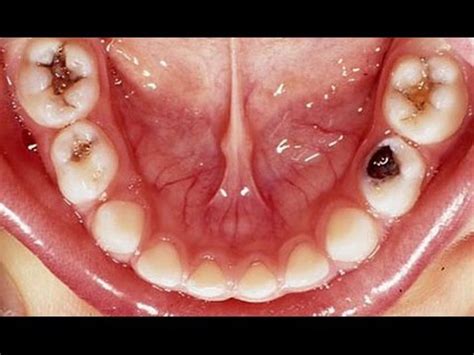 Check spelling or type a new query. Get Rid Of A Toothache Instantly At Home | Best Tooth Pain ...
