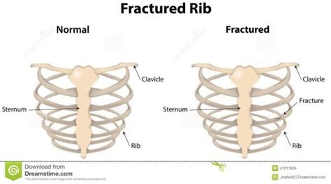 The xyphoid process, the costal margin, the 11th and 12th rib pairs, and the t12 vertebra. Rib Cage Diagram | Human rib cage, Human ribs, Human skeleton
