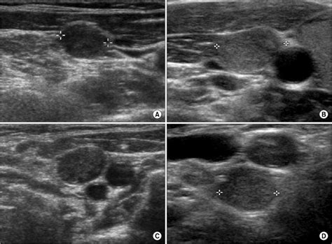 Ultrasound Images Of Central Lymph Node Metastasis A Lnm With A Loss