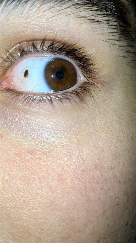 I Have A Freckle On My Eye Mildlyinteresting