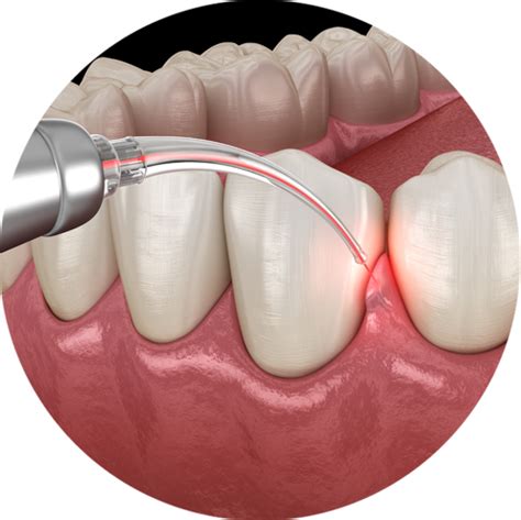 Laser Gum Treatment Periodontitis Treatment Campsie Laser Dental