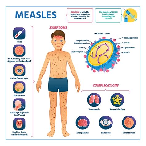 Measles Symptoms Causes Risk Factors And Treatment
