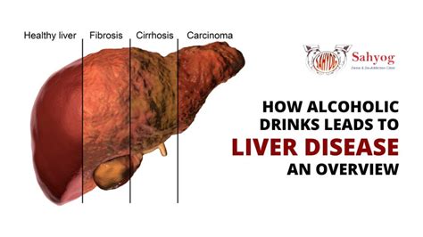 Alcoholic Liver Disease Management Archives Sahyog Clinic