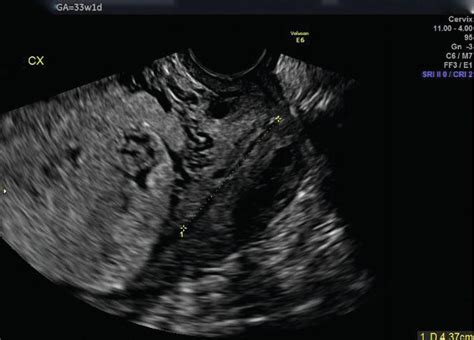 Placental Abnormalities Intechopen