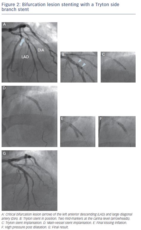 Figure 2 Bifurcation Lesion Stenting With A Tryton Side Branch Stent