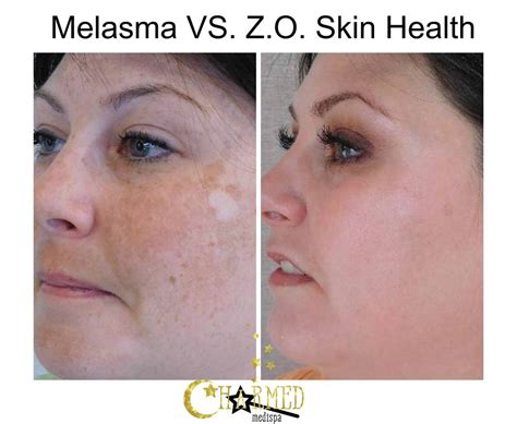 Melasma And Dense Pigmentation Solutions Charmed Medispa