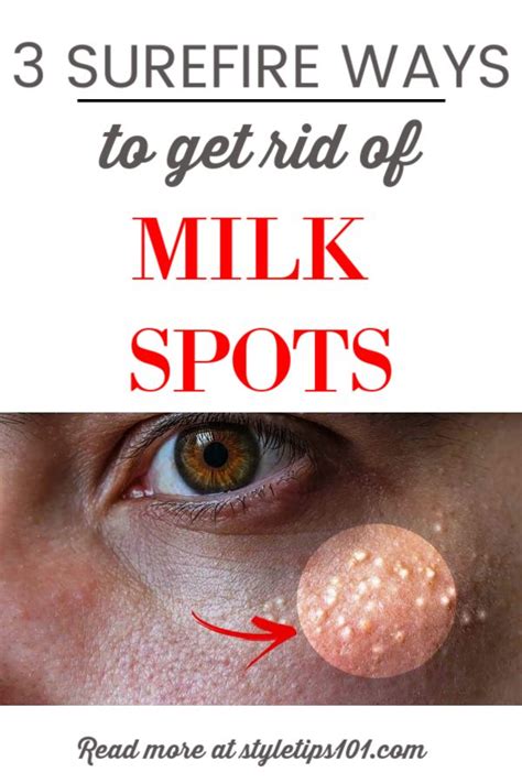 Get Rid Of Milk Spots 3 Natural Ways Milkspots Milia Skincare