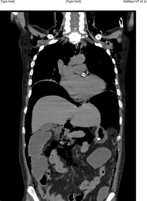 Ct Scan Abdomen Coronal Images Showing Extensive Pneumoperitoneum And