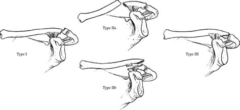 Distal Clavicle Fracture Classification