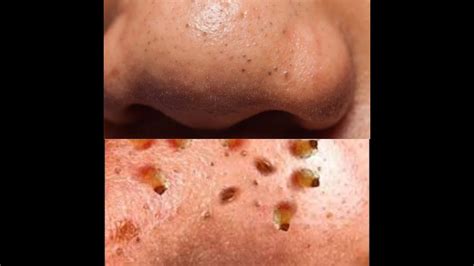 Microdermabrasion For Blackheads Before And After Youtube