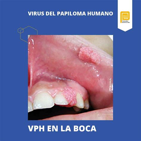 Virus Del Papiloma Humano S Ntomas Y Tratamiento Policl Nica Metropolitana