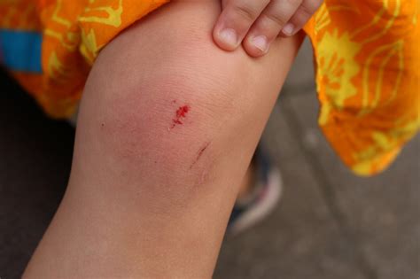 Child With Scraped Knee Has Hurt Photo 4944 Motosha Free Stock