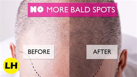 How To Make Hair Grow On Bald Spots Naturally Grow Out Bald Spots And