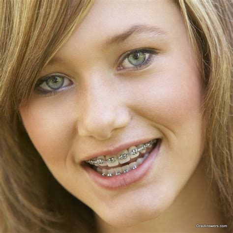 Adult Braces Braces Girls Dental Braces Teeth Braces Woman Smile
