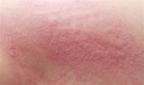 You can reduce your risk of skin cancer by limiting or avoiding exposure to ultraviolet (uv) radiation. What Causes the Lupus Butterfly Rash? - Redorbit