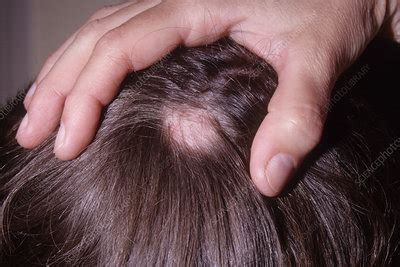 Hair Loss From Lupus Stock Image C Science Photo Library