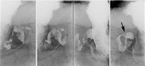 Острая язва двенадцатиперстной кишки диета Язва луковицы двенадцатиперстной кишки: краткое описание, причины Язва луковицы двенадцатиперстной кишки: краткое описание, причины Острая язва двенадцатиперстной кишки диета
