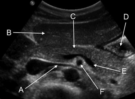 Transverse Ultrasound Scan Of The Upper Abdomen The Bmj
