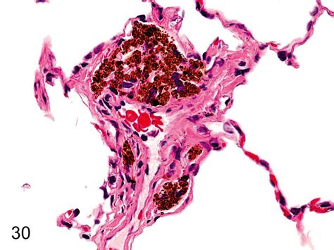 Macrophage With Hemosiderin