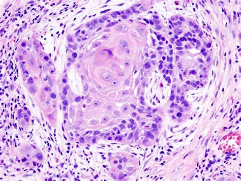 Fileoral Cancer 1 Squamous Cell Carcinoma Histopathology
