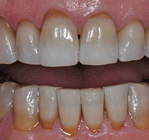 Tooth Discoloration Caused By Acne Treatment In Teens Lee Ann Brady Dmd