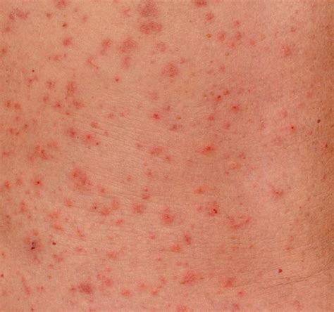 Scabies Causes Symptoms Treatment Pictures And Images