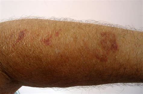 Dark Red Spots On Arm