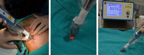Sentinel Lymph Node Biopsy Procedure For Melanoma Download